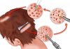 graft extraction and its placement in hair transplant