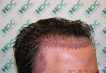 hair transplant delhi