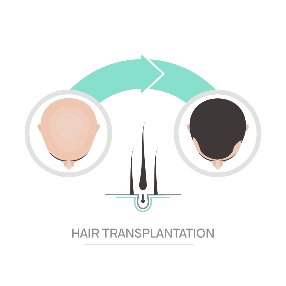 What is Hair Transplant