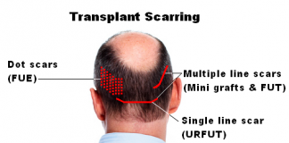 post hair transplant care